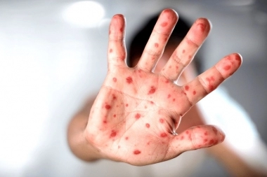 La Viruela del Mono llegó a la provincia de Buenos Aires y Kicillof debió tomar cartas en el asunto