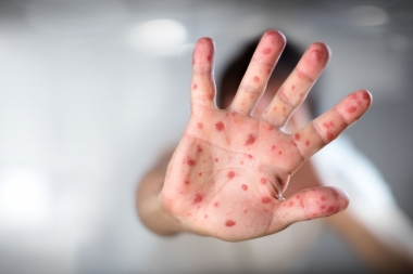 Salud emitió un alerta epidemiológica ante nuevos casos autóctonos de sarampión